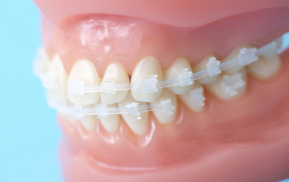 ・透明なブラケットを使用した矯正治療