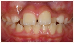 歯並びがガタガタしている場合