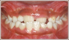 前歯の咬み合わせが反対になっている場合