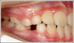 むし歯で乳歯を抜き、そのままにしている場合